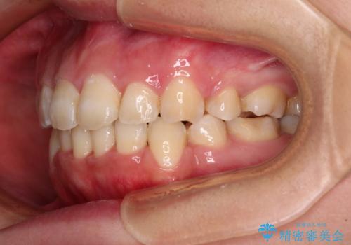 前歯の出っ歯と口の閉じにくさを抜歯矯正で改善 目立たないワイヤー矯正の治療後