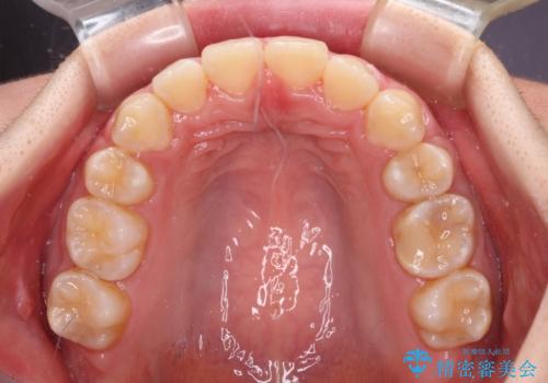 前歯の出っ歯と口の閉じにくさを抜歯矯正で改善 目立たないワイヤー矯正の治療後