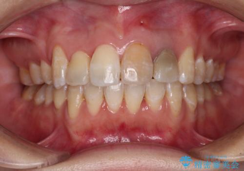 内側にある歯が邪魔　重なった前歯の歯列矯正