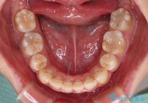 前歯の出っ歯と口の閉じにくさを抜歯矯正で改善 目立たないワイヤー矯正の治療後