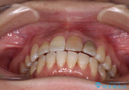 内側にある歯が邪魔 重なった前歯の歯列矯正の治療後