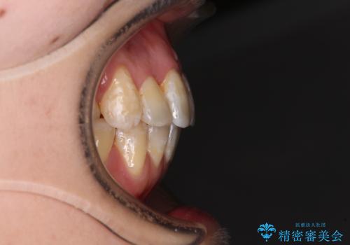 内側にある歯が邪魔 重なった前歯の歯列矯正の治療後
