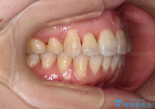 内側にある歯が邪魔 重なった前歯の歯列矯正の治療後