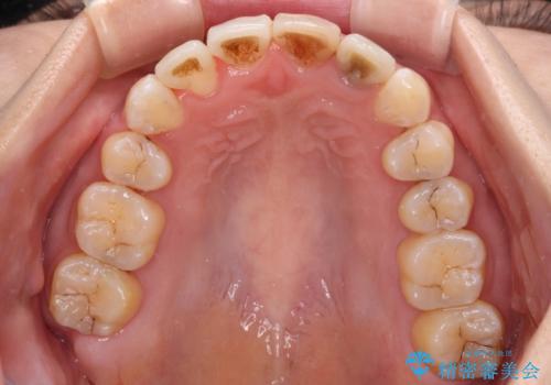 内側にある歯が邪魔　重なった前歯の歯列矯正の治療後