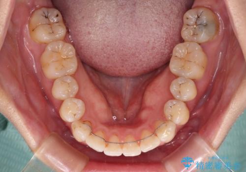 内側にある歯が邪魔 重なった前歯の歯列矯正の治療後
