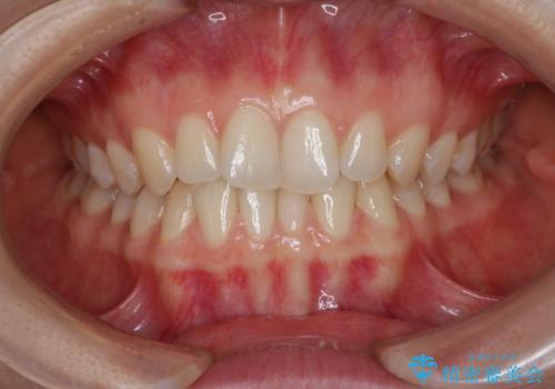 見た目だけじゃない:マウスピースでも短期間で噛み合わせと口元を改善の治療前