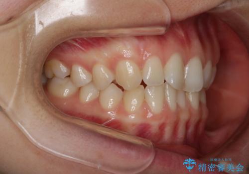 見た目だけじゃない:マウスピースでも短期間で噛み合わせと口元を改善の治療前