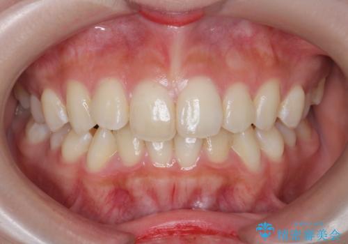 [ インビザラインライト ]   短期間で前歯だけを並べたいの治療前