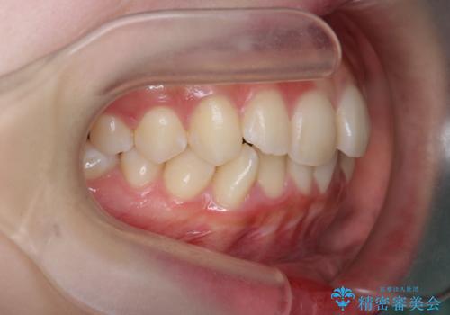 [ インビザラインライト ]   短期間で前歯だけを並べたいの治療前