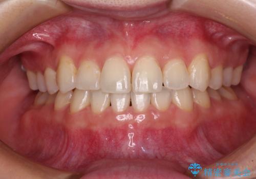 奥歯の欠損を放置　大臼歯を抜歯した矯正治療