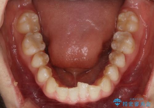 見た目だけじゃない:マウスピースでも短期間で噛み合わせと口元を改善の治療前