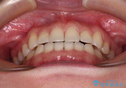 奥歯の欠損を放置 大臼歯を抜歯した矯正治療の治療後