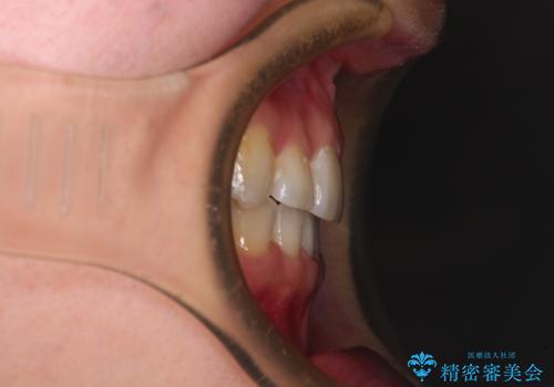 奥歯の欠損を放置 大臼歯を抜歯した矯正治療の治療後