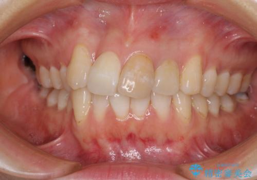 内側にある歯が邪魔 重なった前歯の歯列矯正の症例 治療前