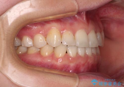 奥歯の欠損を放置 大臼歯を抜歯した矯正治療の治療後