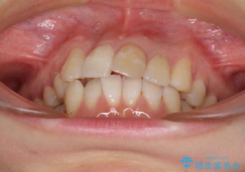 内側にある歯が邪魔 重なった前歯の歯列矯正の治療前