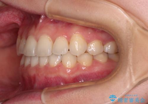 奥歯の欠損を放置 大臼歯を抜歯した矯正治療の治療後