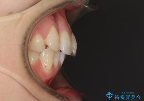 内側にある歯が邪魔 重なった前歯の歯列矯正の治療前