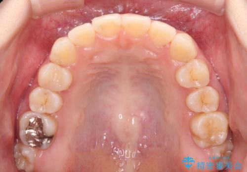 奥歯の欠損を放置　大臼歯を抜歯した矯正治療の治療後
