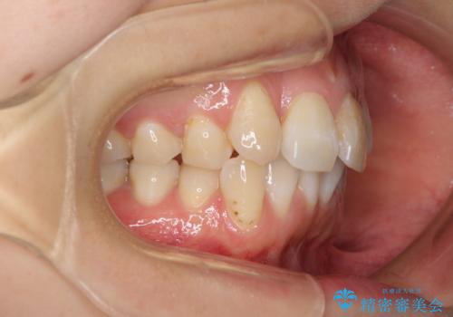 内側にある歯が邪魔 重なった前歯の歯列矯正の治療前