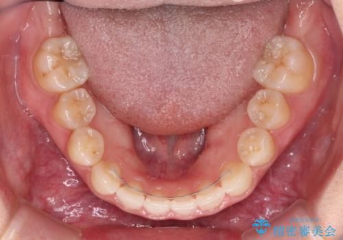 奥歯の欠損を放置　大臼歯を抜歯した矯正治療の治療後