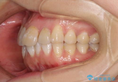 内側にある歯が邪魔 重なった前歯の歯列矯正の治療前