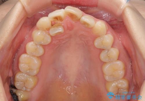 内側にある歯が邪魔　重なった前歯の歯列矯正の治療前