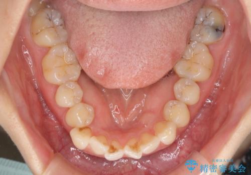 内側にある歯が邪魔　重なった前歯の歯列矯正の治療前