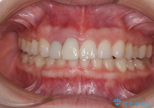 一度諦めた矯正にチャレンジしたい インビザラインとセラミック治療の治療中