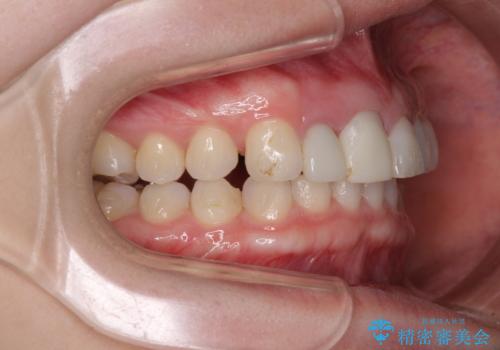 一度諦めた矯正にチャレンジしたい インビザラインとセラミック治療の治療中