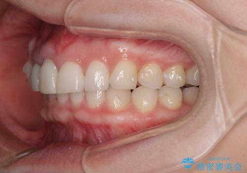 一度諦めた矯正にチャレンジしたい インビザラインとセラミック治療の治療中