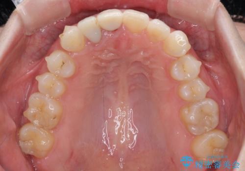 一度諦めた矯正にチャレンジしたい インビザラインとセラミック治療の治療中