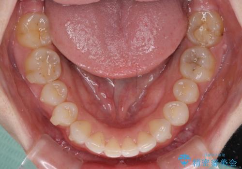 一度諦めた矯正にチャレンジしたい インビザラインとセラミック治療の治療中