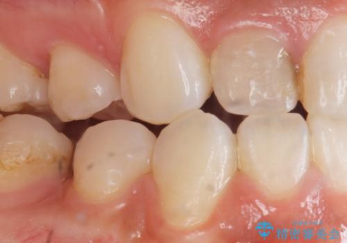 前歯の色と隙間が気になる 早く治したい 矯正は嫌 30代女性の治療前