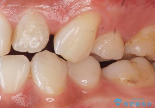 前歯の色と隙間が気になる 早く治したい 矯正は嫌 30代女性の治療前