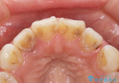 前歯の色と隙間が気になる 早く治したい 矯正は嫌 30代女性の治療前