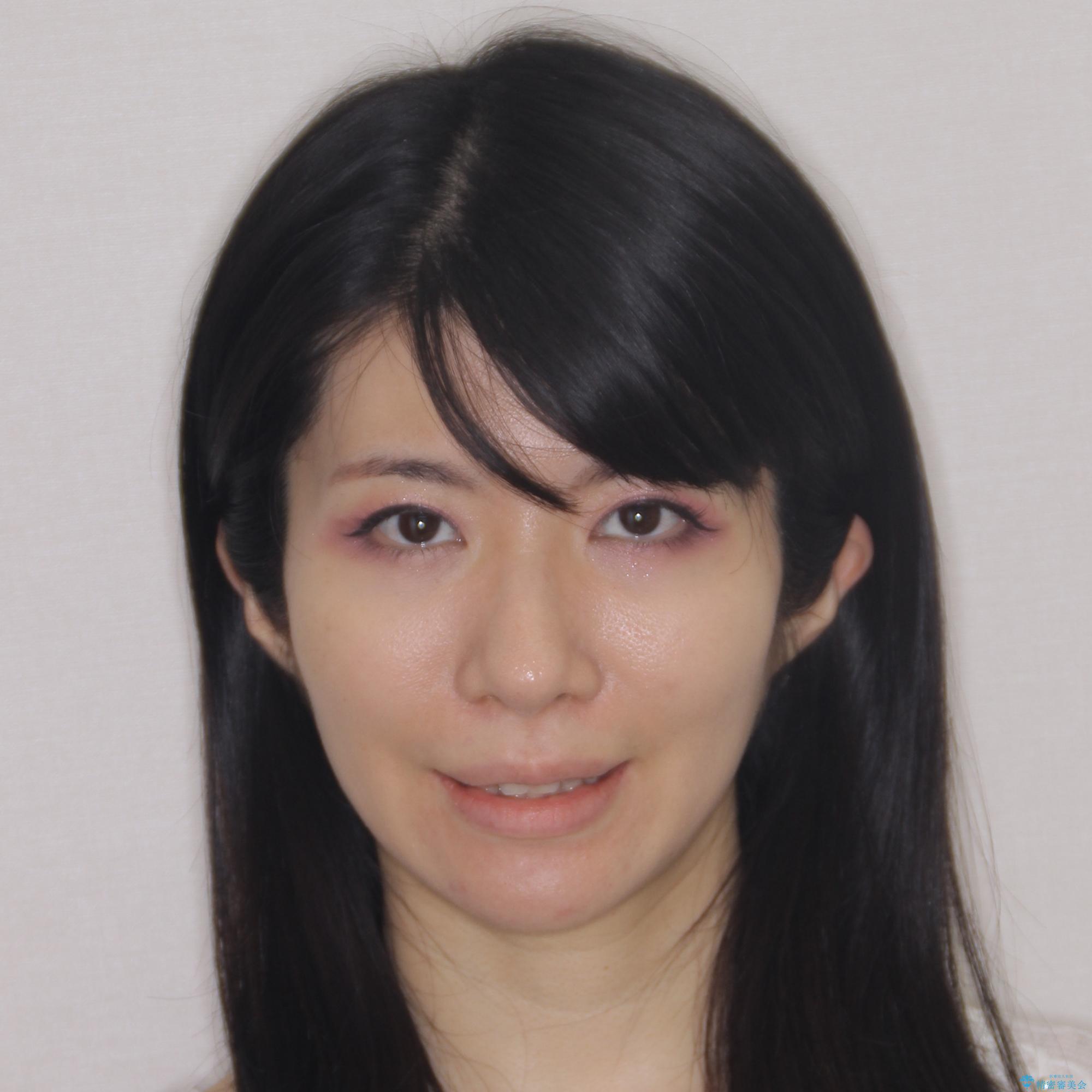 【モニター】前歯のデコボコと奥歯の虫歯 インビザライン治療と奥歯のセラミック治療の治療前(顔貌)