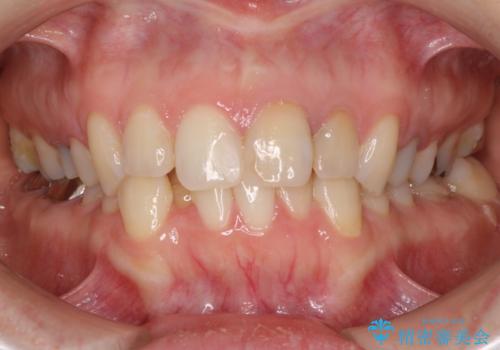 【モニター】前歯のデコボコと奥歯の虫歯　インビザライン治療と奥歯のセラミック治療の症例 治療前