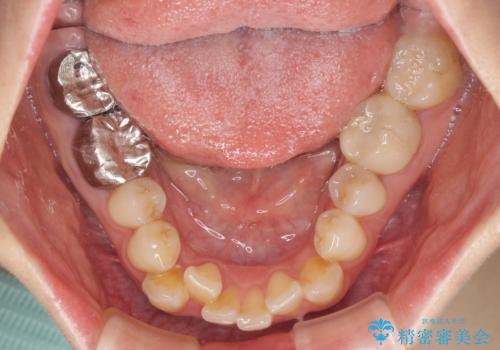 【モニター】前歯のデコボコと奥歯の虫歯　インビザライン治療と奥歯のセラミック治療の治療前