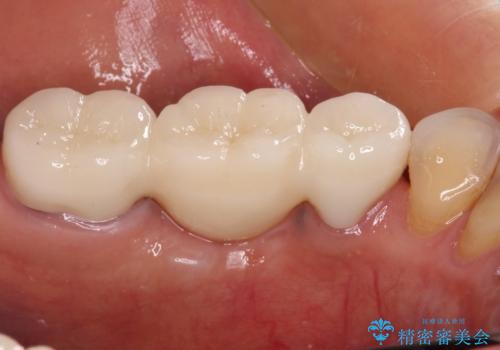抜かずに保存した奥歯が痛くて臭う セラミックブリッジによる欠損補綴治療の治療後