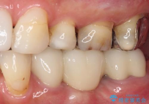 抜かずに保存した奥歯が痛くて臭う セラミックブリッジによる欠損補綴治療の治療後