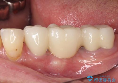抜かずに保存した奥歯が痛くて臭う セラミックブリッジによる欠損補綴治療の治療後