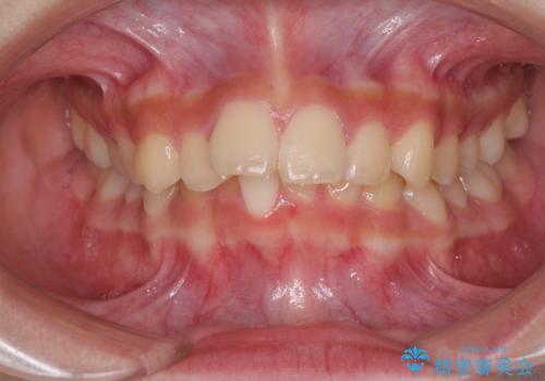 下の前歯が隠れてしまうほど深い咬み合わせ　高校生のインビザライン矯正治療の症例 治療前