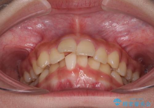 下の前歯が隠れてしまうほど深い咬み合わせ 高校生のインビザライン矯正治療の治療前