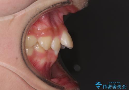 下の前歯が隠れてしまうほど深い咬み合わせ 高校生のインビザライン矯正治療の治療前