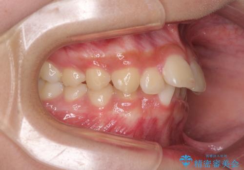 下の前歯が隠れてしまうほど深い咬み合わせ 高校生のインビザライン矯正治療の治療前