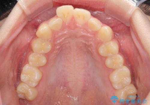 下の前歯が隠れてしまうほど深い咬み合わせ 高校生のインビザライン矯正治療の治療前