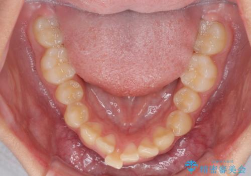 下の前歯が隠れてしまうほど深い咬み合わせ　高校生のインビザライン矯正治療の治療前