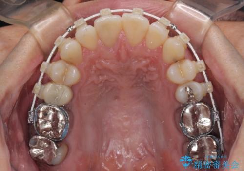 受け口傾向の咬み合わせ　前歯のデコボコをワイヤー矯正で素早く改善の治療中