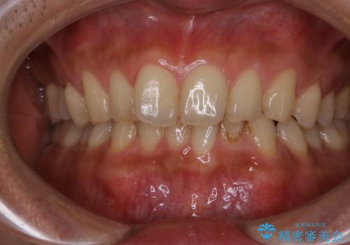 毎日コーヒーを飲む 歯を白くしたいの治療前